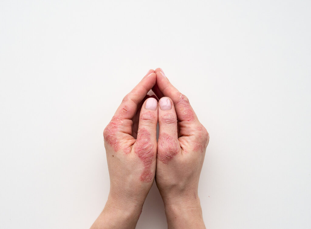 Ruky s príznakmi psoriatickej artritídy spojené na bielom podklade