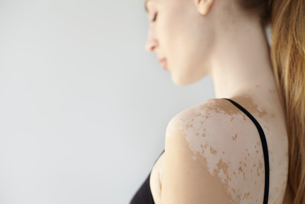 Pityriasis versicolor na chrbte