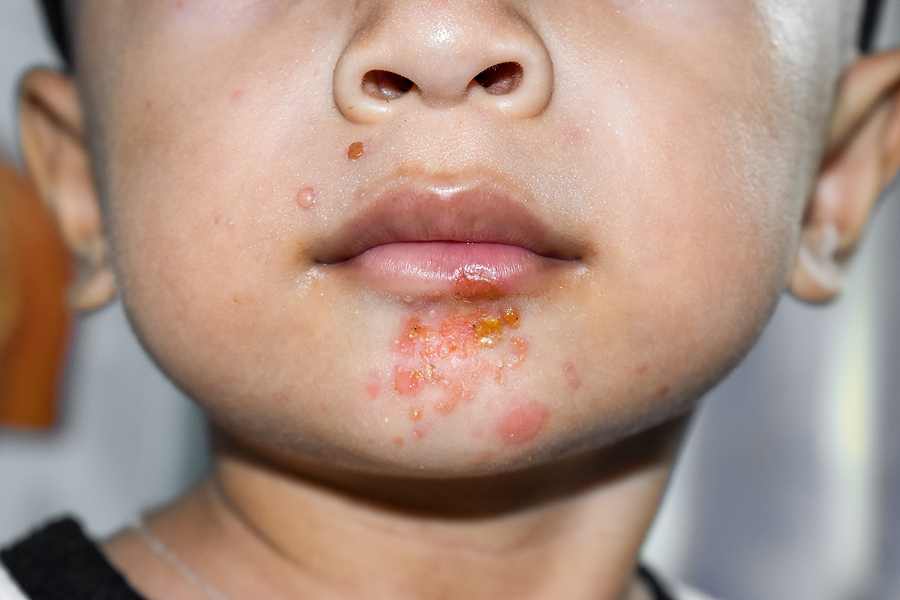 Chlapec s príznakmi impetigo na brade