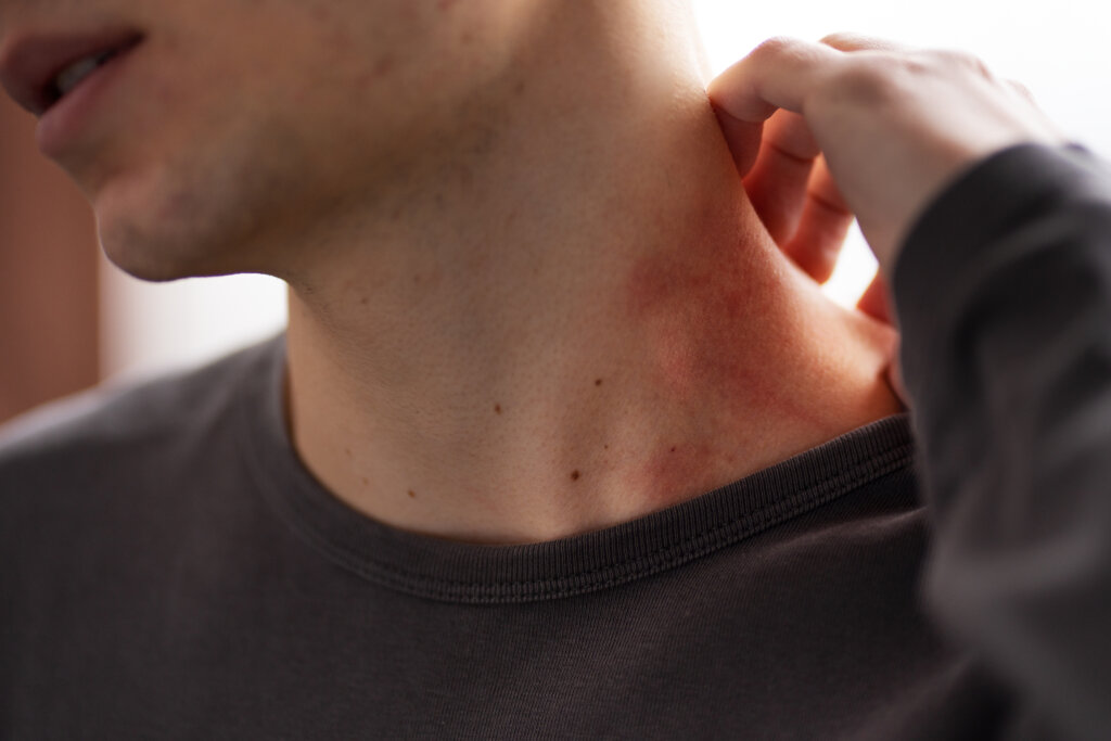 Svrbenie počas toho, ako trpíte Pityriasis versicolor
