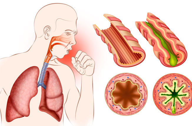Astma zobrazená z anatomického pohľadu