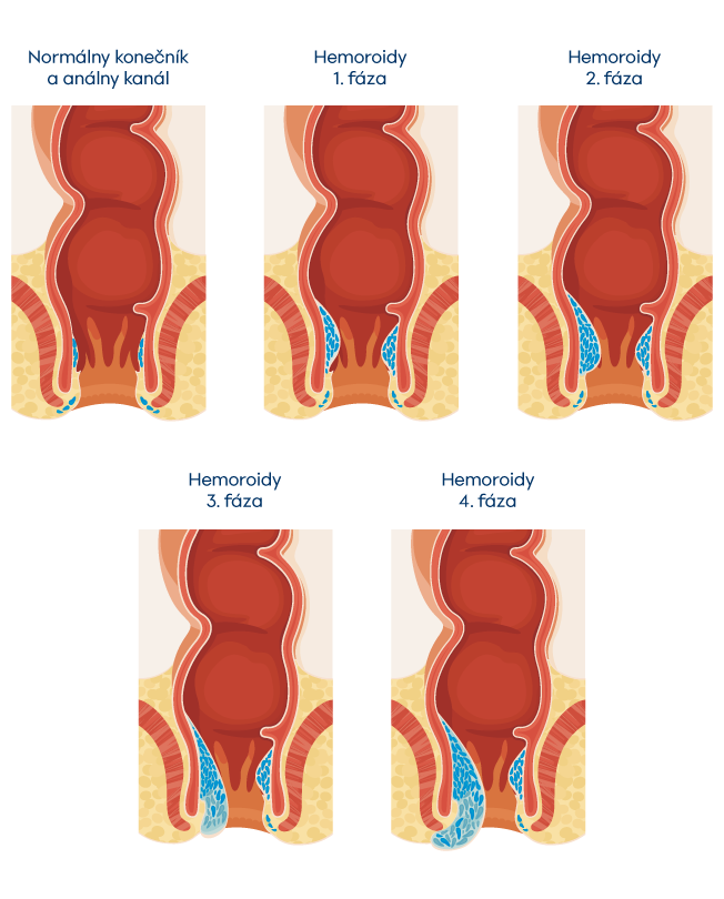 Fázy hemoroidov