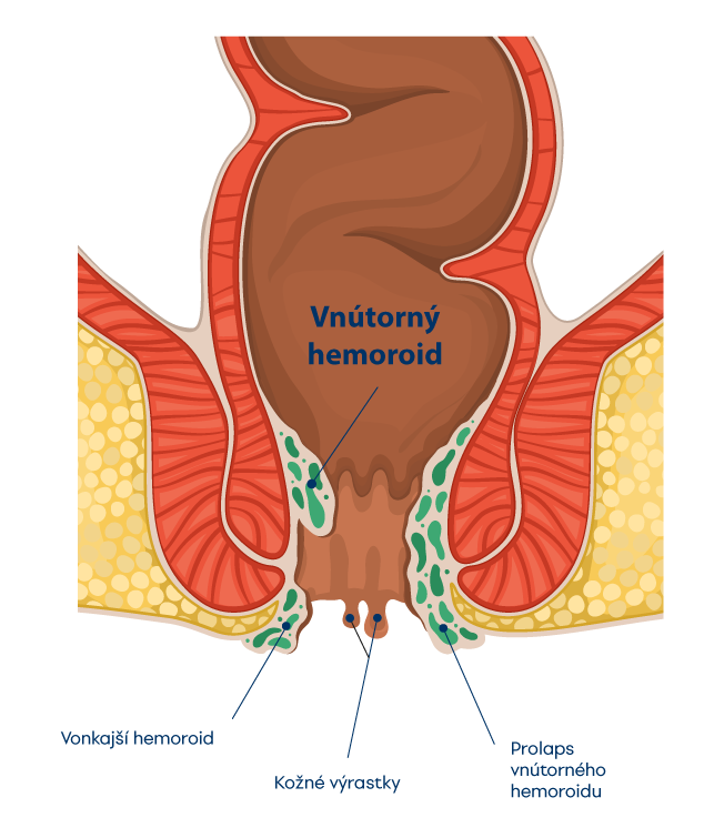 Hemoroidy