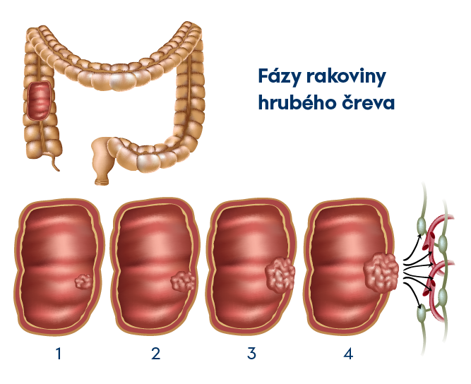 Fázy rakoviny hrubého čreva