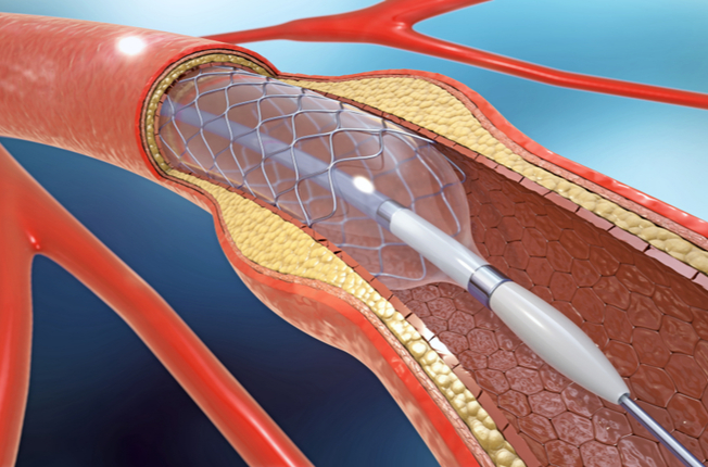 Koronárny stent