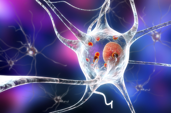 Parkinsonova choroba – Lewyho telieska