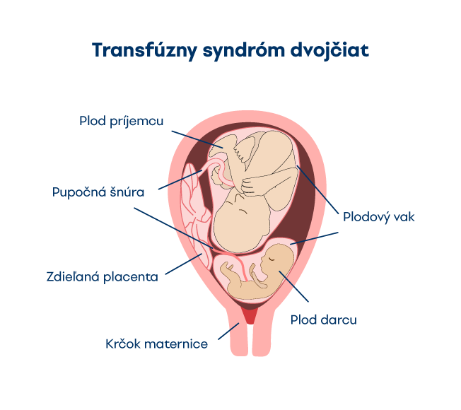 Tansfúzny syndŕom