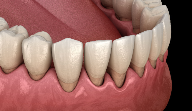 Ustúpené ďasná spôsobujú odhalenie krčkov až koreňov zuba