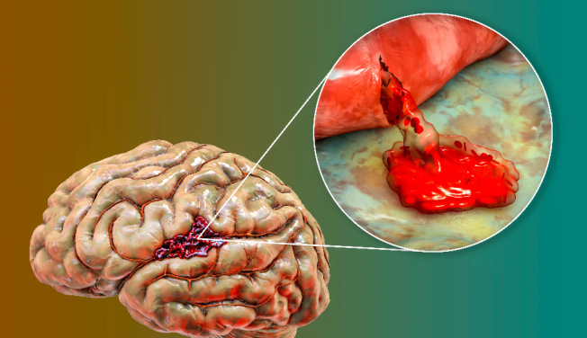 Krvácanie do mozgu