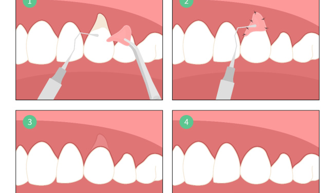Ako prebieha gingivoplastika a nahradenie ďasna