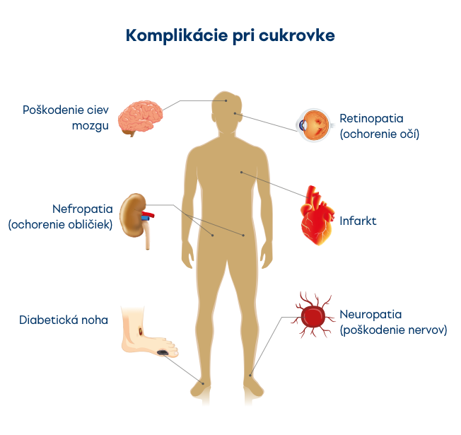 Komplikácie pri cukrovke