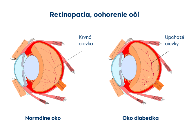 Retinopatia