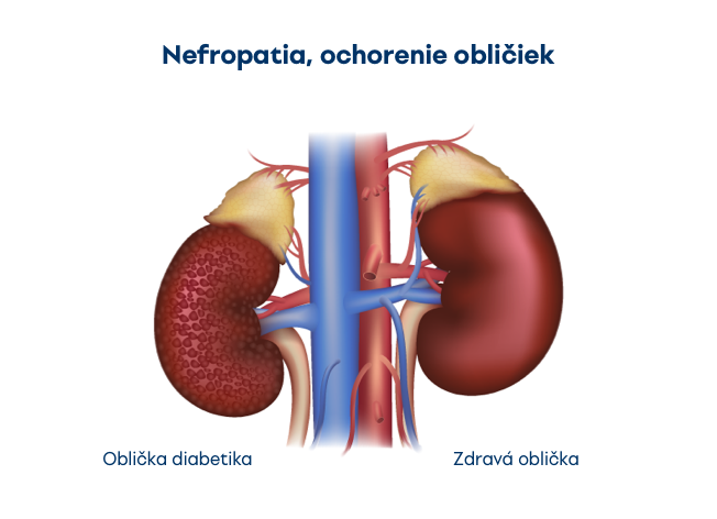 Ochorenie obličiek pri cukrovke