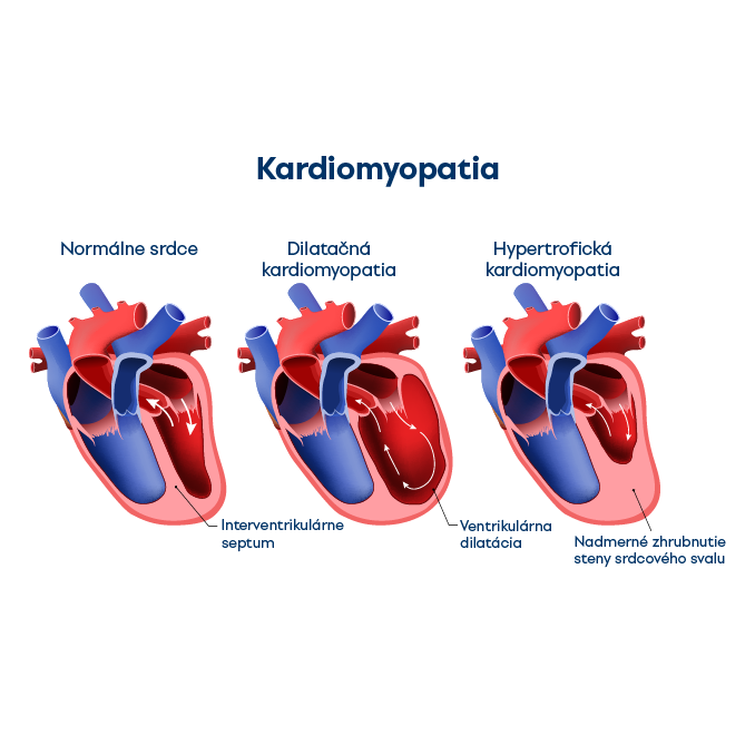 Porovnanie typov hypertrofie vzhľadom k normálnemu srdcu (zľava - normálne srdce, ľavostranná excentrická hypertrofia, ľavostranná koncentrická hypertrofia) 