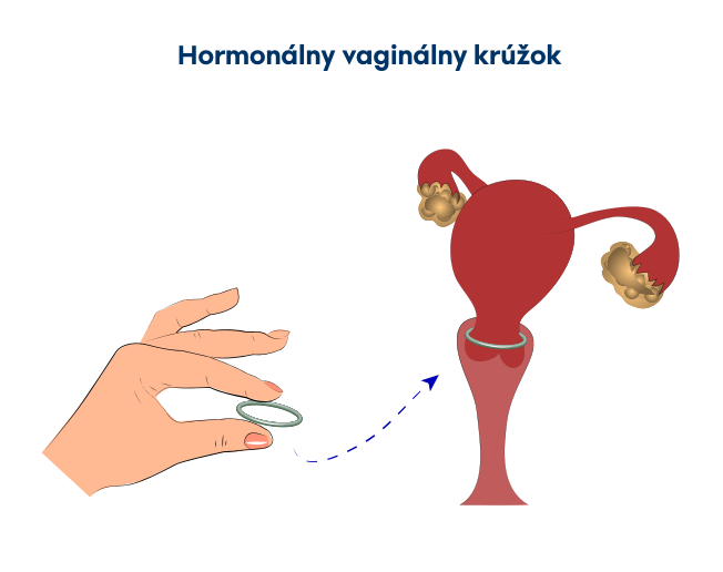 Vaginálny krúžok