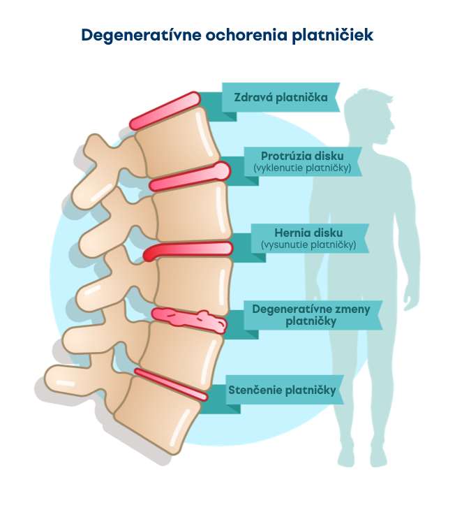 Degeneratívne zmeny platničky