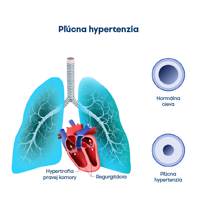 Pulmonálna hypertenzia ako príčina vzniku pravostrannej hypertrofie 