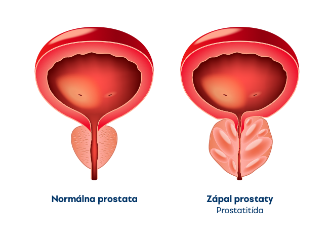 Prostata