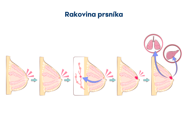 Štádiá rakoviny prsníka