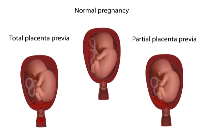 placenta previa