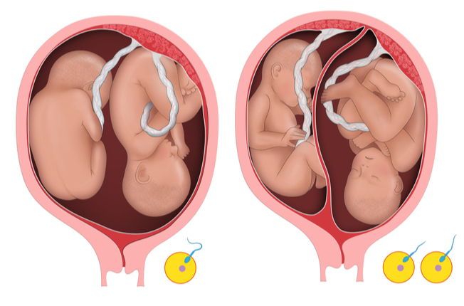 Jednovaječne, dvojvaječné dvojčatá