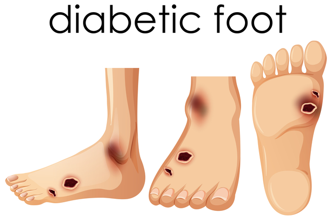 Diabetická noha