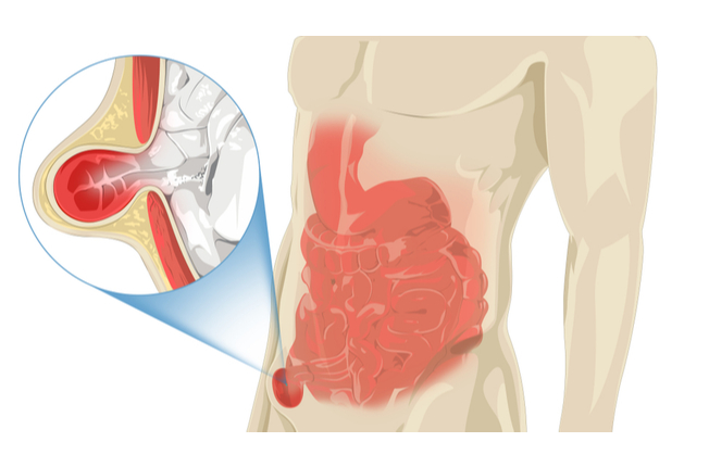 Inguinálna hernia