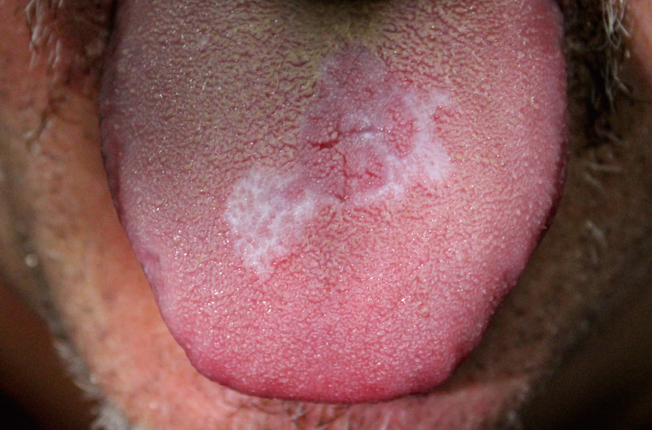 Lichen planus