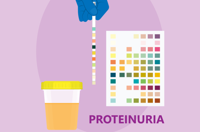 Proteinúria – testovacie prúžky 