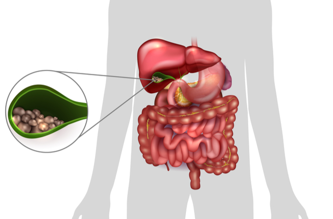 Umiestnenie žlčníka a žlčové kamene 