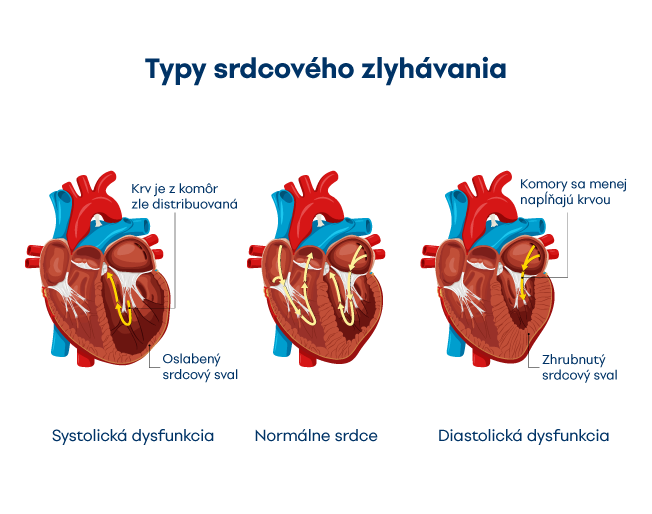 Typy zlyhávania srdca