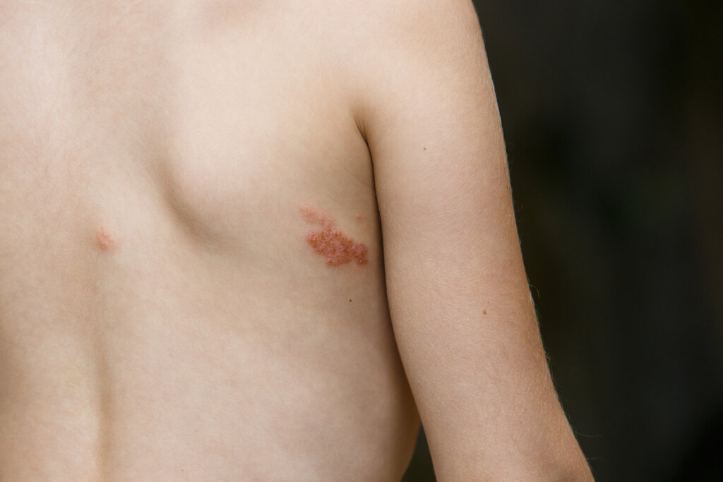 pásový opar na dieťati