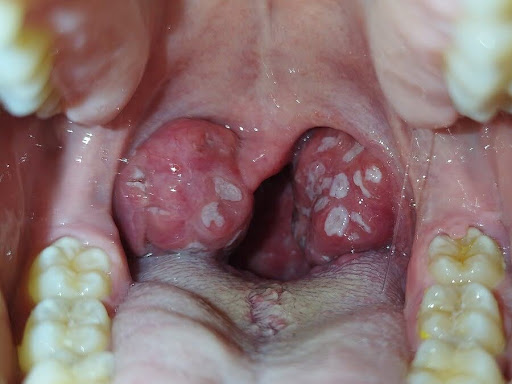 Obrazok typickeho hrdla pri angine