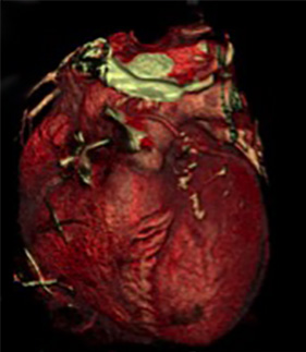 Srdce po operácii – 3D priestorový model zobrazený pomocou softvérovej rekonštrukcie z CT koronarografie (VRT)