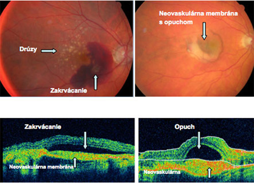 Zakrvácanie a opuch pri vlhkej forme ochorenia (foto sietnice, OCT)