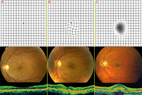 A - fyziologický obraz, B - suchá forma ochorenia, C - vlhká forma ochorenia. Zhora dole: Amslerova mriežka - foto sietnice – OCT