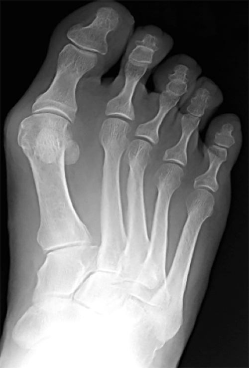 RTG snímok pravej nohy v stoji, s nálezom deformity hallux valgus