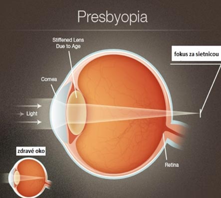 Prechod svetla optickými médiami presbyopického a zdravého oka