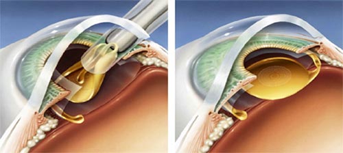 Implantácia multifokálnej vnútroočnej šošovky pri PRELEX operácii