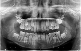 Ortopantomogram zmiešaného chrupu u detského pacienta